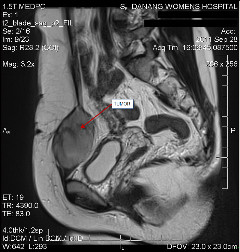 Chụp MRI tử cung- phần phụ- vùng chậu: giúp xác định vị trí khối lạc nội mạc, kích thước, tính chất,…